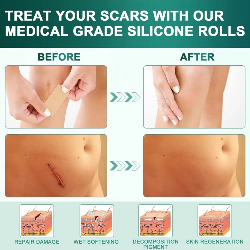 South Moon Silicone Scars Sheets-Suitable for all kinds of scars